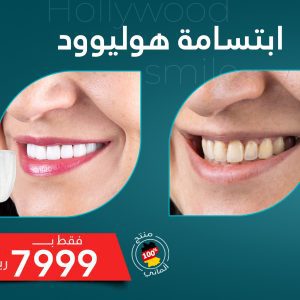 ابتسامة هوليوود