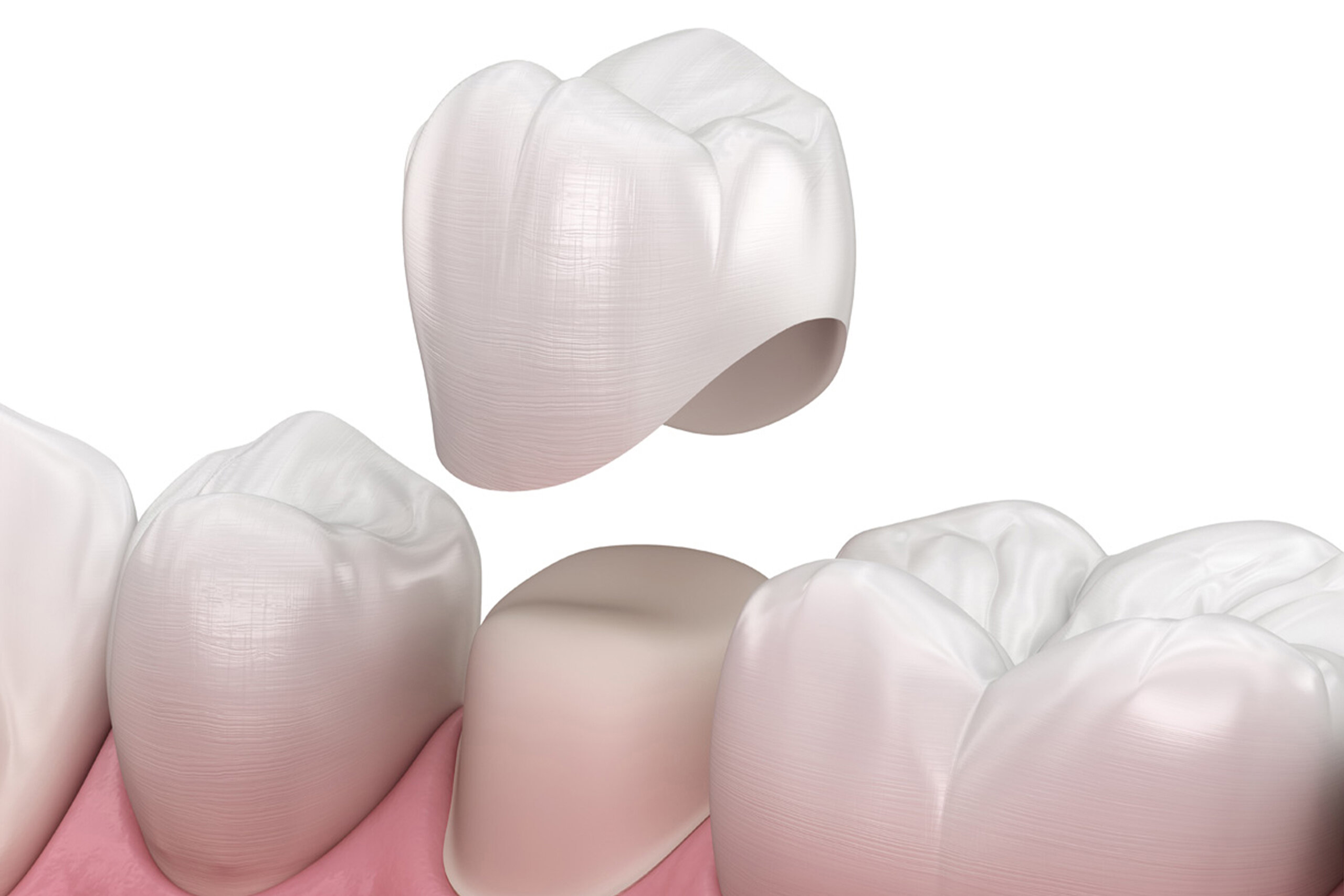 تركيبات الأسنان - نخبة المجتمع